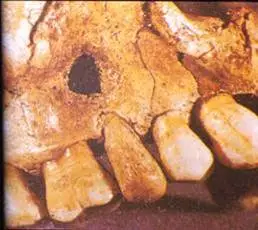 Dientes con Implantes