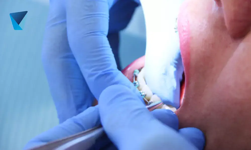 Cerveza y vino, bebidas alcohólicas que dejan manchas en nuestros dientes