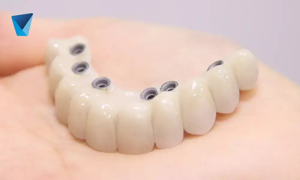 ¿Cuanto tiempo dura un implante dental?