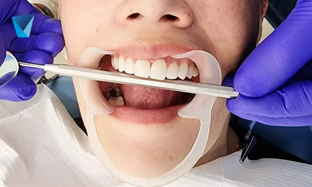 El diseño de sonrisa en Santiago