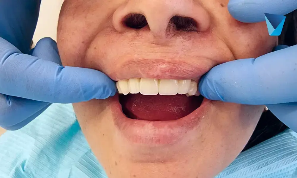 ¿Cómo arreglar sonrisa gingival?