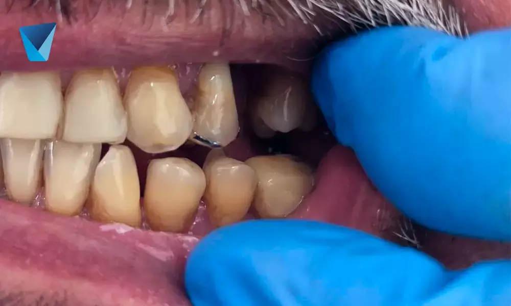 Uso de las coronas dentales
