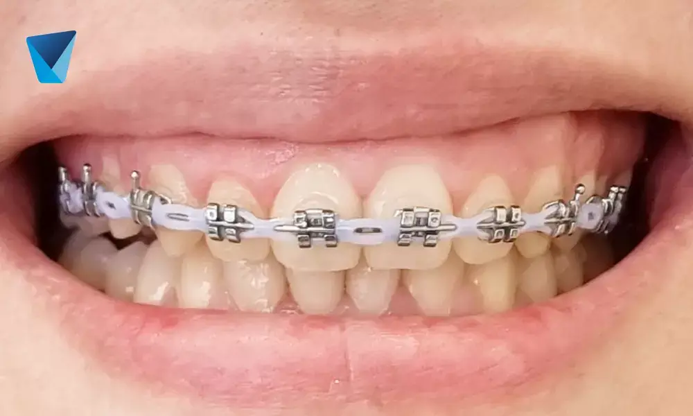 Ortodoncia maxilofacial y cirugía ortognática