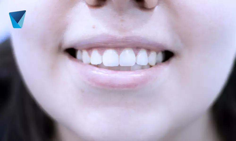 Diferencias entre estética y cosmética dental