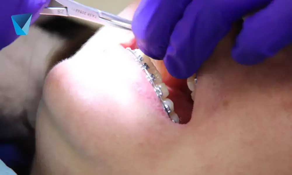 8 Consejos para el cuidado dental en verano