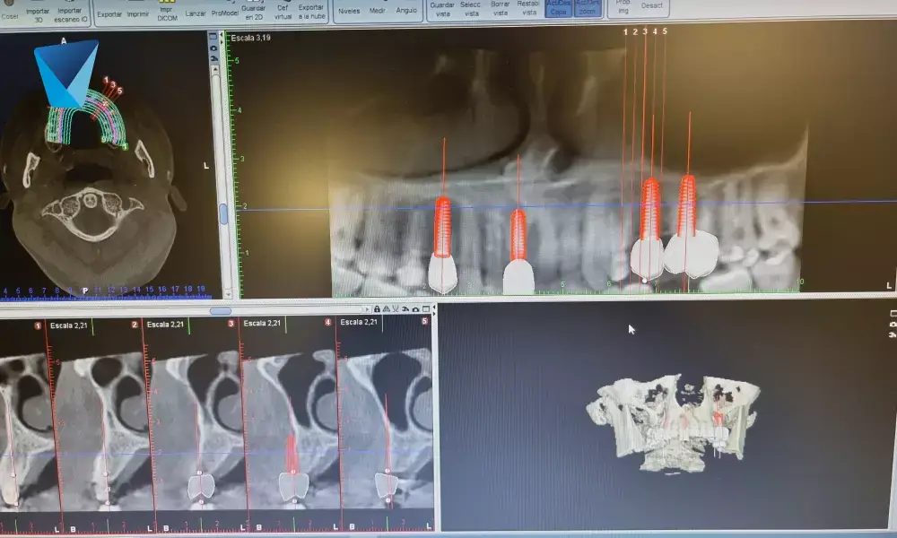Implantologia dental: Cirugía de elevación del seno maxilar