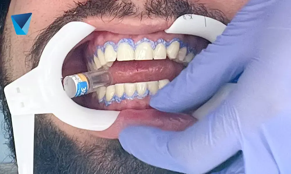 Limpieza dental profesional, un básico de la estética dental