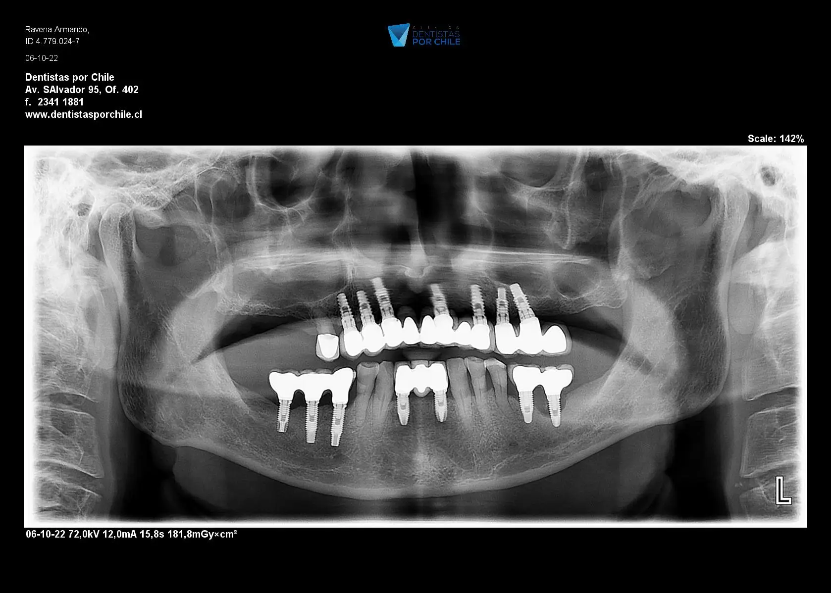 Implantes Dentales en Maxilar Superior: ¡Renueva tu Sonrisa!