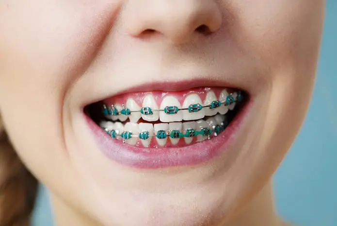 Brackets Metálicos en boca